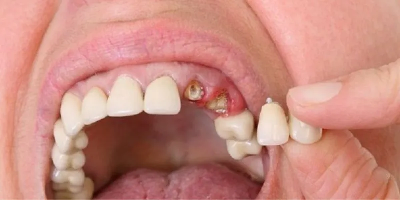 Nằm mơ rụng răng – Điềm báo và con số nào mang lại may mắn? 3 Nằm mơ thấy nhiều răng rơi ra cùng lúc